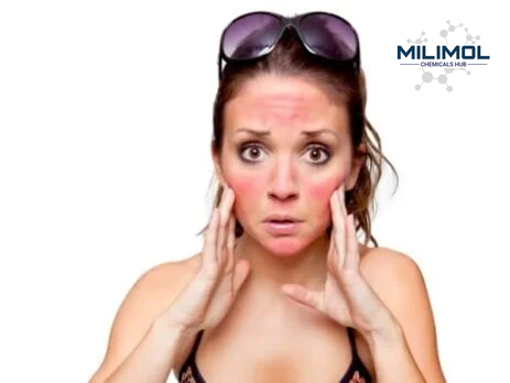 sunburn-woman-463×348